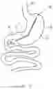Fig. 06 - Activable bougie for performing gastroplasty