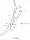 Fig. 08 - Activable bougie for performing gastroplasty