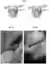 Fig. 02 - Periodontal gel composition and method of use