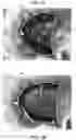 Fig. 05 - Autonomously growing implantable device