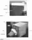 Fig. 13 - Infused demineralized bone fibers