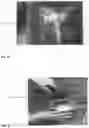 Fig. 16 - Infused demineralized bone fibers