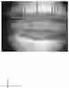 Fig. 12 - IMPLANTABLE VASCULAR GRAFTS