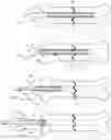 Fig. 15 - Drug eluting insert for implantable body