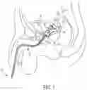 Fig. 02 - Catheter and Method for Inducing Negative Pressure in a Patient's Bladder