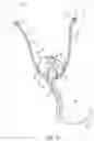 Fig. 15 - Catheter and Method for Inducing Negative Pressure in a Patient's Bladder