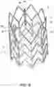 Fig. 07 - IMPLANTABLE INTRAVASCULAR VENTRICULAR ASSIST DEVICE