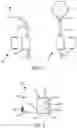 Fig. 03 - Implantable fluid management system for treating heart failure