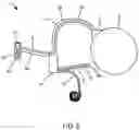 Fig. 06 - Implantable fluid management system for treating heart failure