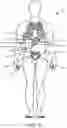Fig. 10 - Implantable fluid management system for treating heart failure