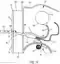 Fig. 11 - Implantable fluid management system for treating heart failure