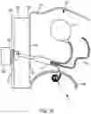 Fig. 12 - Implantable fluid management system for treating heart failure