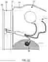 Fig. 16 - Implantable fluid management system for treating heart failure