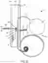 Fig. 17 - Implantable fluid management system for treating heart failure