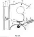 Fig. 25 - Implantable fluid management system for treating heart failure