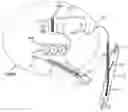 Fig. 01 - Cannula, ECMO assistance system