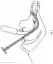 Fig. 03 - Intubation stylets