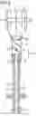 Fig. 03 - Catheter device having a catheter and an actuation device