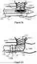 Fig. 11 - System And Method For Treatment Via Bodily Drainage Or Injection