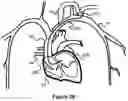 Fig. 15 - System And Method For Treatment Via Bodily Drainage Or Injection