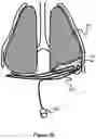 Fig. 16 - System And Method For Treatment Via Bodily Drainage Or Injection