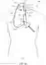 Fig. 03 - Systems and methods for treating a carotid artery