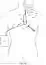 Fig. 06 - Systems and methods for treating a carotid artery
