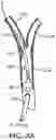 Fig. 07 - Systems and methods for treating a carotid artery