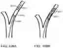 Fig. 104 - Systems and methods for treating a carotid artery