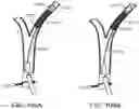 Fig. 105 - Systems and methods for treating a carotid artery
