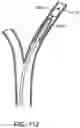 Fig. 108 - Systems and methods for treating a carotid artery