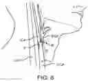 Fig. 12 - Systems and methods for treating a carotid artery