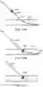 Fig. 31 - Systems and methods for treating a carotid artery