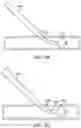 Fig. 37 - Systems and methods for treating a carotid artery