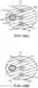 Fig. 54 - Systems and methods for treating a carotid artery