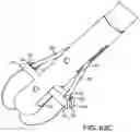 Fig. 61 - Systems and methods for treating a carotid artery