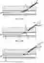 Fig. 66 - Systems and methods for treating a carotid artery