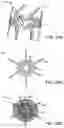 Fig. 83 - Systems and methods for treating a carotid artery