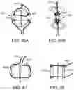 Fig. 84 - Systems and methods for treating a carotid artery