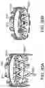 Fig. 86 - Systems and methods for treating a carotid artery