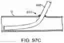 Fig. 96 - Systems and methods for treating a carotid artery