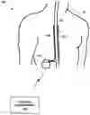Fig. 01 - High frequency stimulation using low frequency titration gauge
