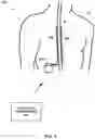 Fig. 02 - High frequency stimulation using low frequency titration gauge