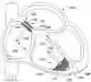 Fig. 01 - Leadless pacemaker with collapsible anchoring device