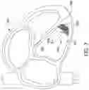 Fig. 07 - Leadless pacemaker with collapsible anchoring device