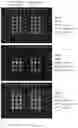 Fig. 09 - ASSAY FOR C5B-9 DEPOSITION IN COMPLEMENT-ASSOCIATED DISORDERS