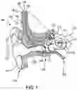 Fig. 02 - Prosthesis adapter