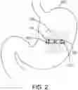 Fig. 04 - Devices for detecting organ contents using impedance and methods of using the same to provide various therapies