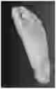 Fig. 01 - Custom foot orthotic and system and method for designing of a custom foot orthotic
