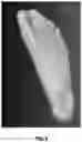 Fig. 07 - Custom foot orthotic and system and method for designing of a custom foot orthotic
